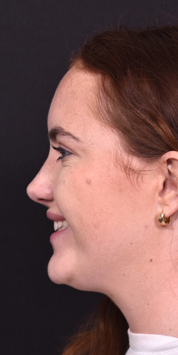 Atlanta preservation rhinoplasty ultrasonic before after expert top Atlanta nose job best