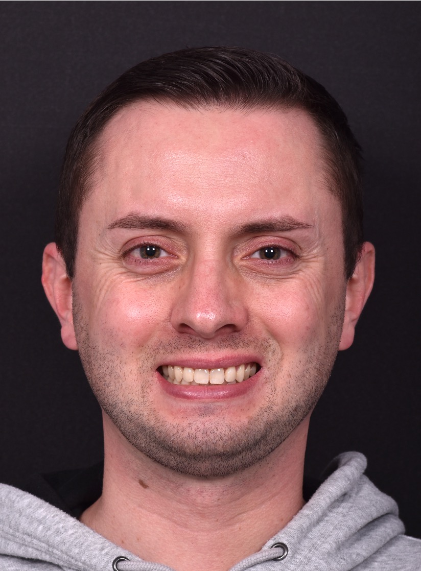 Atlanta rhinoplasty near me expert best before after results preservation piezo ultrasonic Turkey nosejob nose