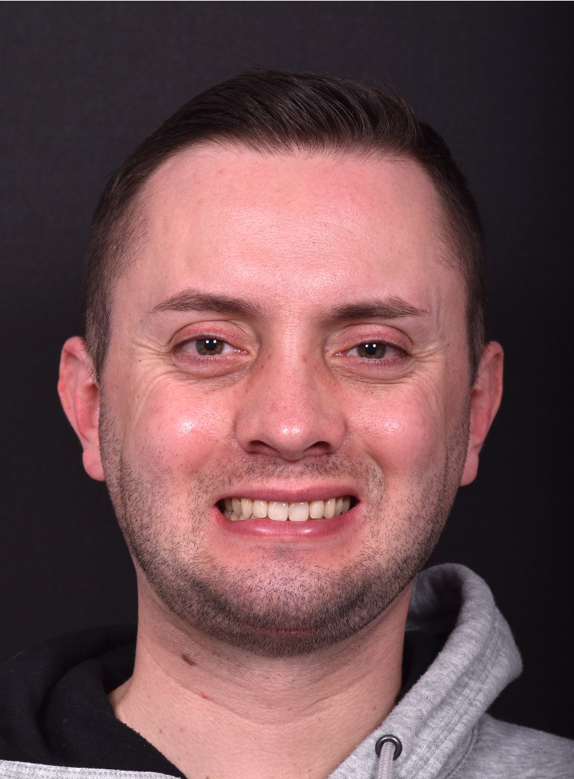 Atlanta rhinoplasty near me expert best before after results preservation piezo ultrasonic Turkey nosejob nose