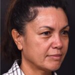 Before and after photos showing natural-looking results of upper blepharoplasty performed by Dr. Inessa Fishman at Aviva Plastic Surgery. A 52-year-old woman achieved a more refreshed, youthful appearance with smoother, lifted upper eyelids and hidden scars, 4 months post-surgery.