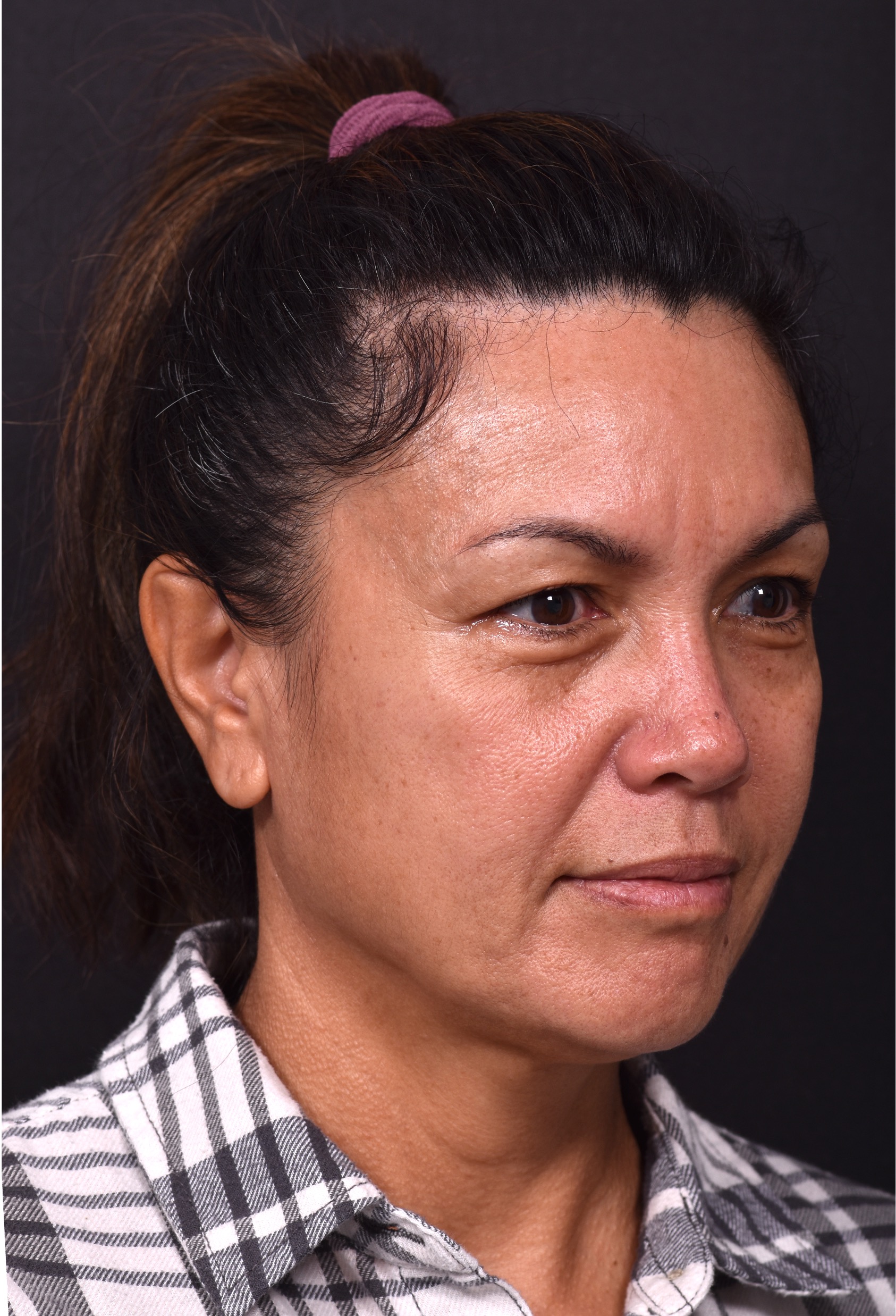 Before and after photos showing natural-looking results of upper blepharoplasty performed by Dr. Inessa Fishman at Aviva Plastic Surgery. A 52-year-old woman achieved a more refreshed, youthful appearance with smoother, lifted upper eyelids and hidden scars, 4 months post-surgery.