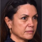 Before and after photos showing natural-looking results of upper blepharoplasty performed by Dr. Inessa Fishman at Aviva Plastic Surgery. A 52-year-old woman achieved a more refreshed, youthful appearance with smoother, lifted upper eyelids and hidden scars, 4 months post-surgery.