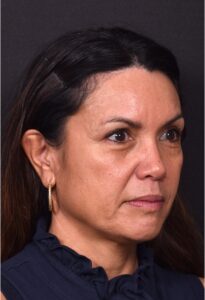 Before and after photos showing natural-looking results of upper blepharoplasty performed by Dr. Inessa Fishman at Aviva Plastic Surgery. A 52-year-old woman achieved a more refreshed, youthful appearance with smoother, lifted upper eyelids and hidden scars, 4 months post-surgery.