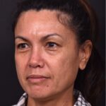 Before and after photos showing natural-looking results of upper blepharoplasty performed by Dr. Inessa Fishman at Aviva Plastic Surgery. A 52-year-old woman achieved a more refreshed, youthful appearance with smoother, lifted upper eyelids and hidden scars, 4 months post-surgery.