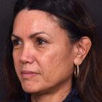 Before and after photos showing natural-looking results of upper blepharoplasty performed by Dr. Inessa Fishman at Aviva Plastic Surgery. A 52-year-old woman achieved a more refreshed, youthful appearance with smoother, lifted upper eyelids and hidden scars, 4 months post-surgery.