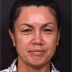 Before and after photos showing natural-looking results of upper blepharoplasty performed by Dr. Inessa Fishman at Aviva Plastic Surgery. A 52-year-old woman achieved a more refreshed, youthful appearance with smoother, lifted upper eyelids and hidden scars, 4 months post-surgery.