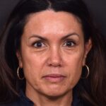 Before and after photos showing natural-looking results of upper blepharoplasty performed by Dr. Inessa Fishman at Aviva Plastic Surgery. A 52-year-old woman achieved a more refreshed, youthful appearance with smoother, lifted upper eyelids and hidden scars, 4 months post-surgery.