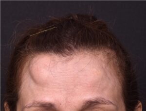 Forehead lump bump knot painless scarles surgery excision hidden expert best near me collagen