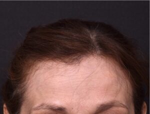 Forehead lump bump knot painless scarles surgery excision hidden expert best near me collagen