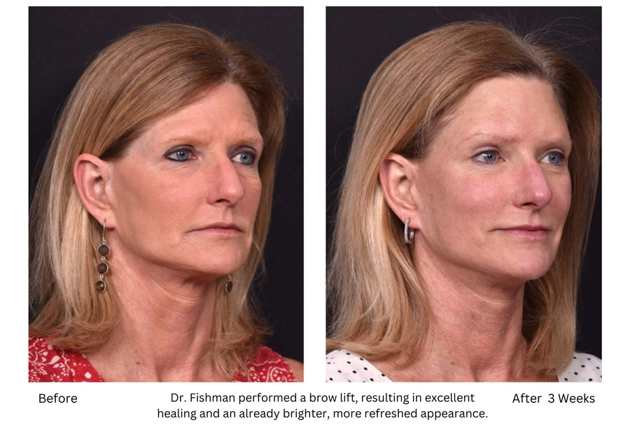 Dr. Fishman performed a brow lift, resulting in excellent healing and an already brighter, more refreshed appearance.