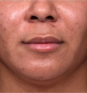 Lip lift surgery Atlanta best near me before and after plastic surgery collagen cosmetic facial balancing