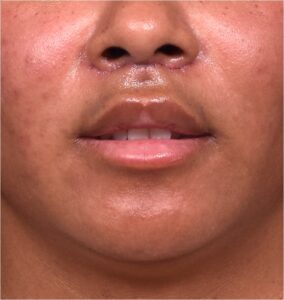 Lip lift surgery Atlanta best near me before and after plastic surgery collagen cosmetic facial balancing