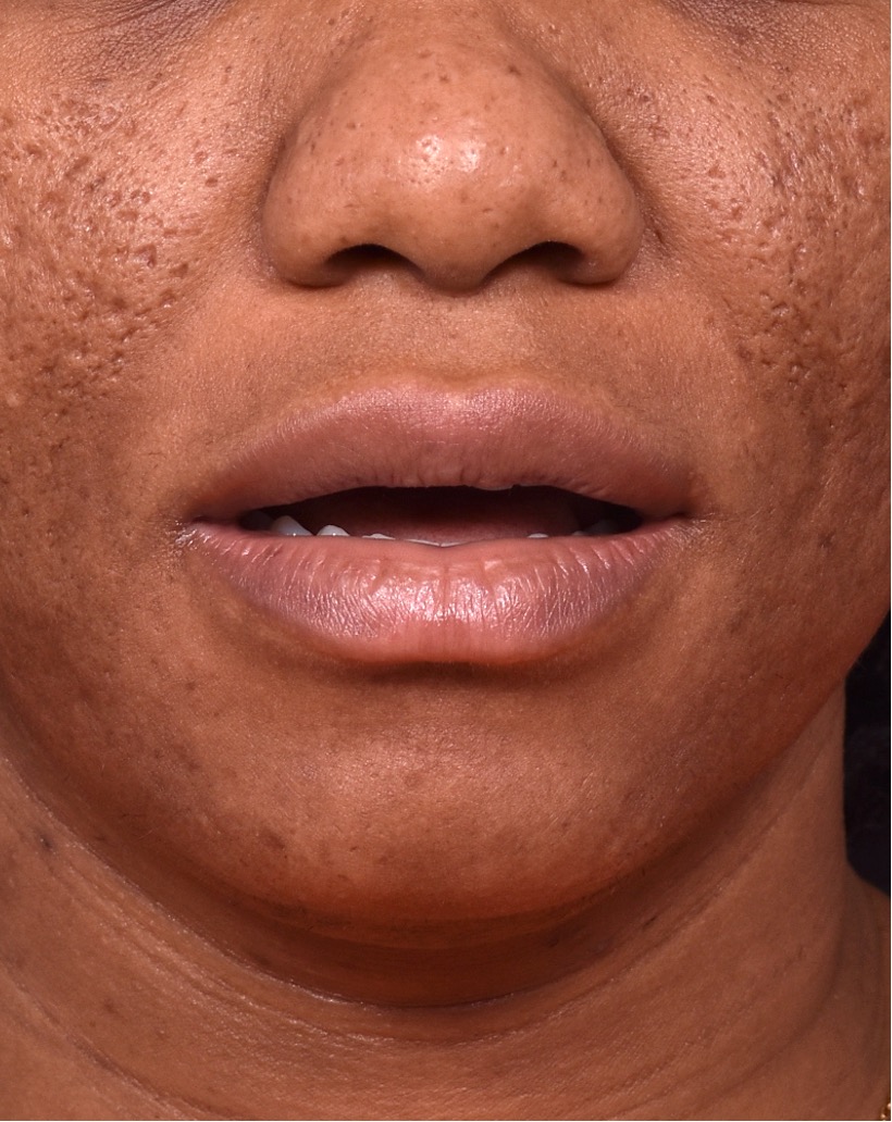 Lip reduction before and after results surgery plastic surgeon near me collagen
