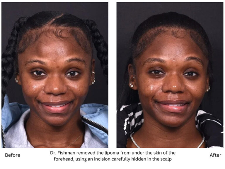 How We Treat Forehead Lipomas and Osteomas at Aviva Plastic Surgery
