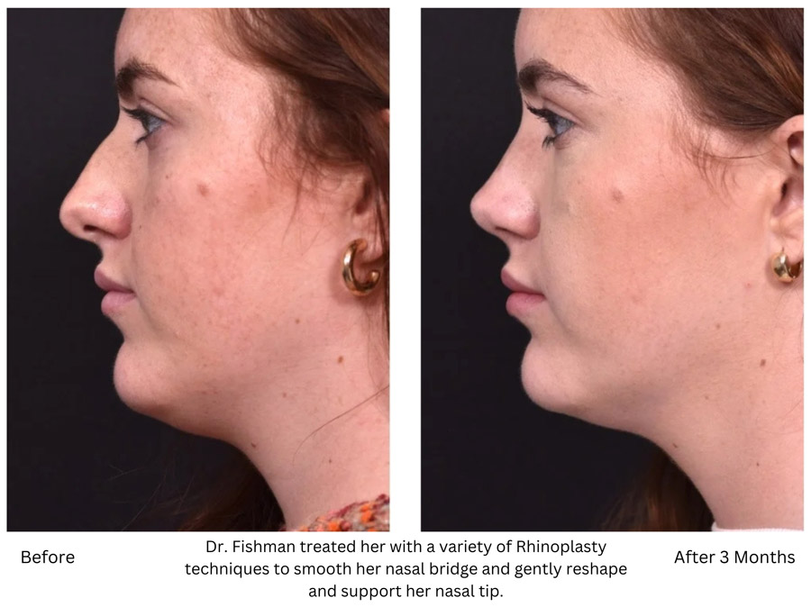 Dr. Fishman treated her with a variety of Rhinoplasty techniques to smooth her nasal bridge and gently reshape and support her nasal tip.