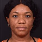 Lip reduction Atlanta best expert near me collagen before after photos results