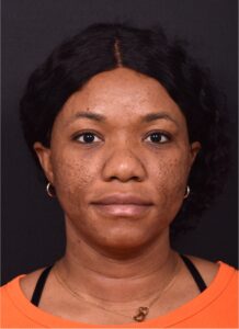 Lip reduction Atlanta best expert near me collagen before after photos results