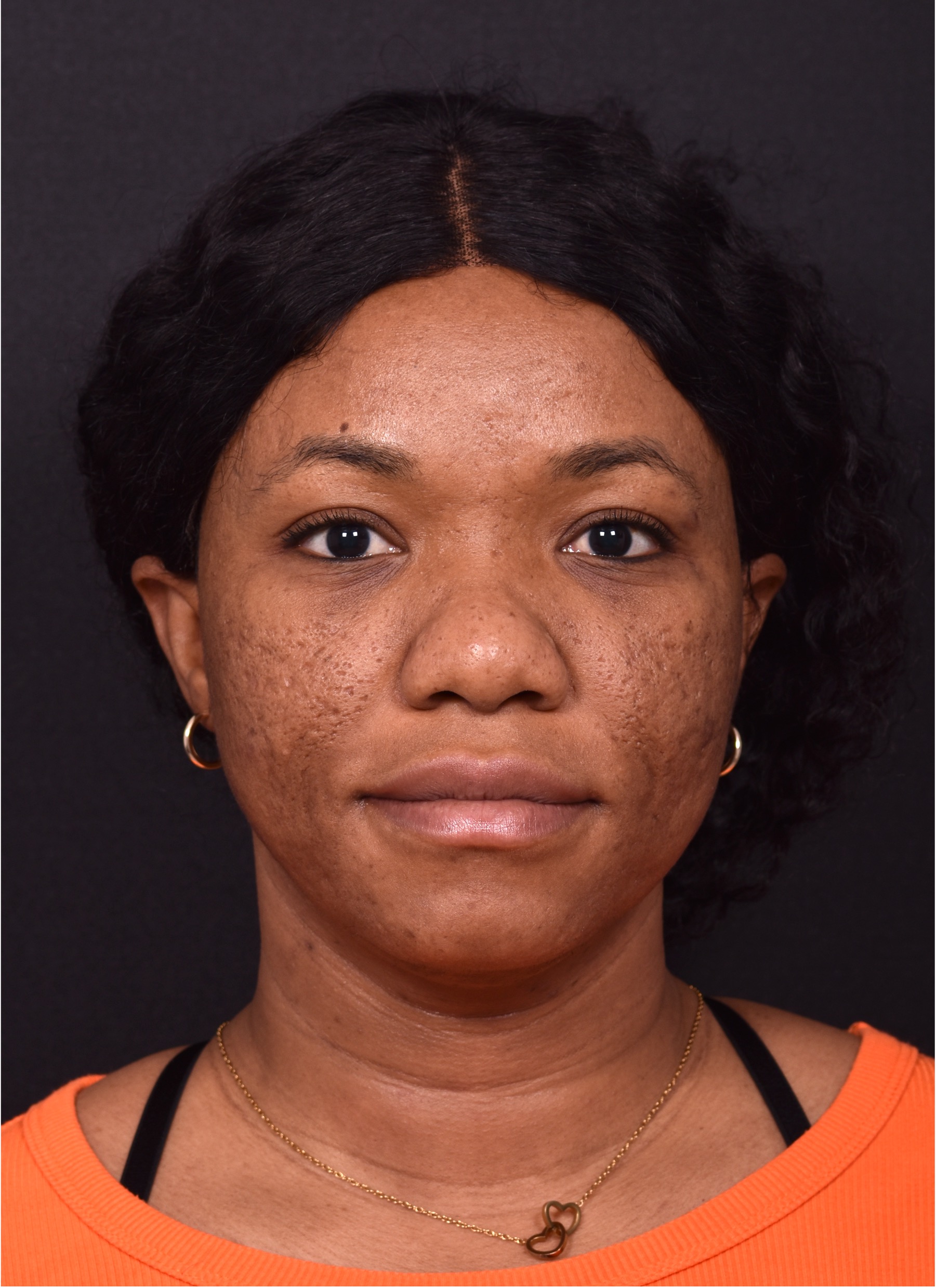 Lip reduction Atlanta best expert near me collagen before after photos results