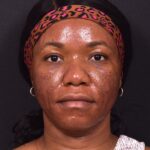 Lip reduction Atlanta best expert near me collagen before after photos results