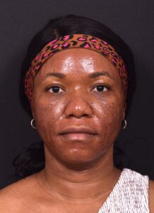 Lip reduction Atlanta best expert near me collagen before after photos results