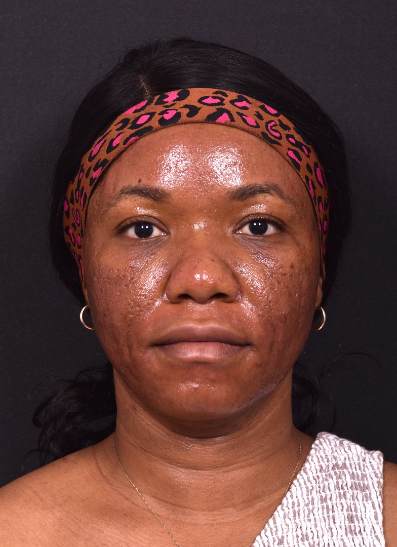 Lip reduction Atlanta best expert near me collagen before after photos results