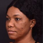 Lip reduction Atlanta best expert near me collagen before after photos results