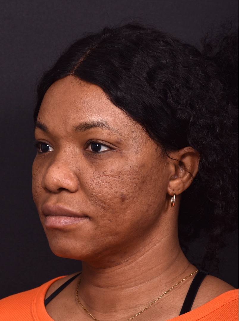 Lip reduction Atlanta best expert near me collagen before after photos results