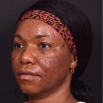 Lip reduction Atlanta best expert near me collagen before after photos results