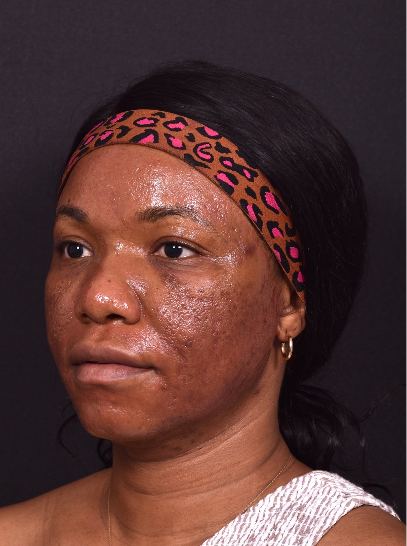 Lip reduction Atlanta best expert near me collagen before after photos results