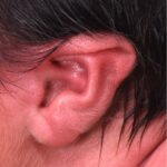Earwell newborn baby ear correction treatment otoplast best expert near me before after results nonsurgical collagen
