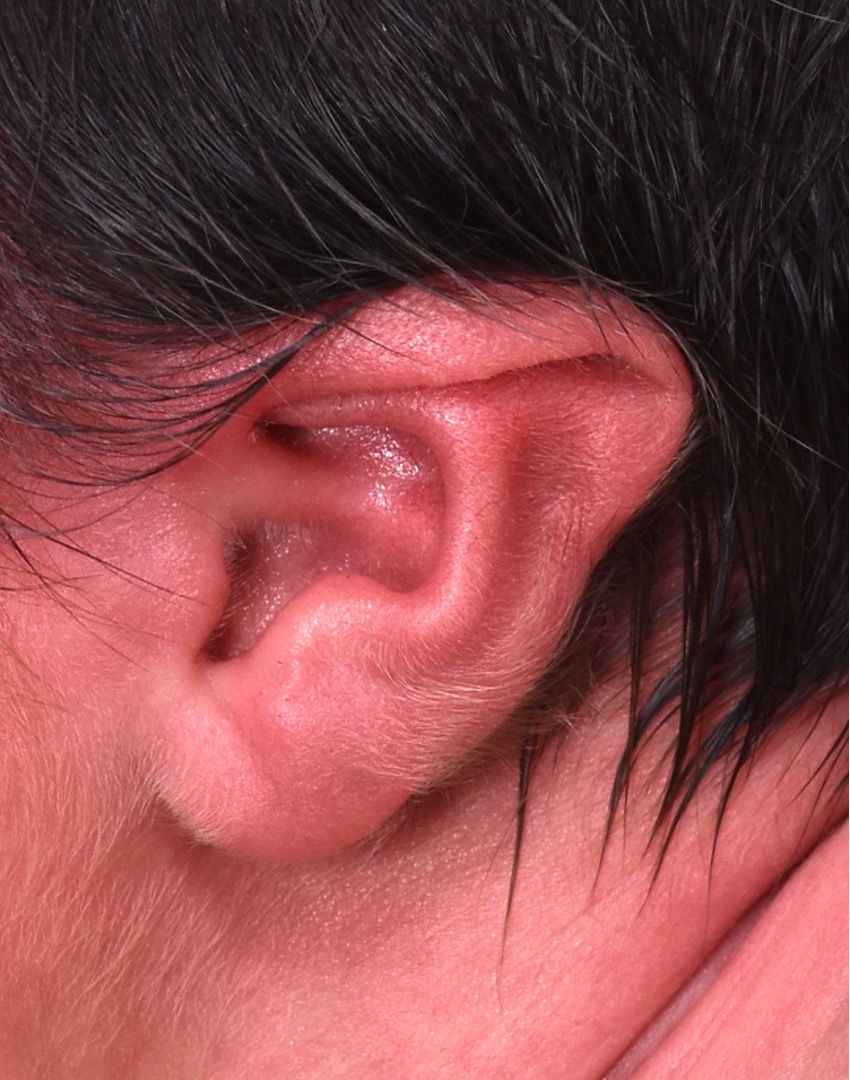 Earwell newborn baby ear correction treatment otoplast best expert near me before after results nonsurgical collagen