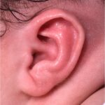Earwell newborn baby ear correction treatment otoplast best expert near me before after results nonsurgical collagen