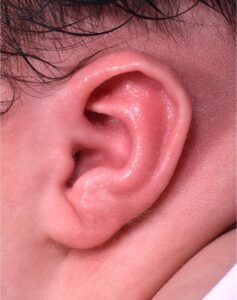 Earwell newborn baby ear correction treatment otoplast best expert near me before after results nonsurgical collagen