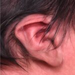 Earwell newborn baby ear correction treatment otoplasty best expert near me before after results nonsurgical collagen