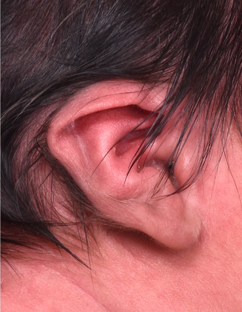 Earwell newborn baby ear correction treatment otoplasty best expert near me before after results nonsurgical collagen