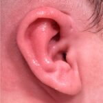 Earwell newborn baby ear correction treatment otoplasty best expert near me before after results nonsurgical collagen