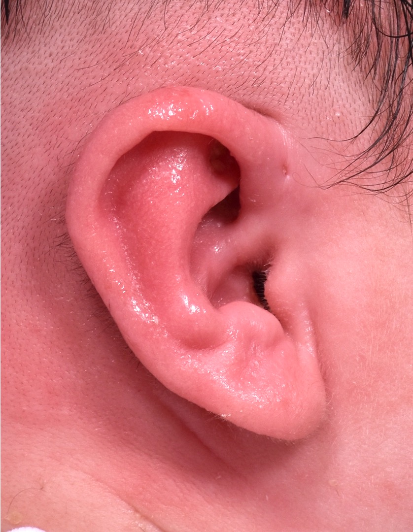Earwell newborn baby ear correction treatment otoplasty best expert near me before after results nonsurgical collagen
