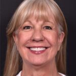 Before and after rhinoplasty results showing improved nasal shape and facial balance by Dr. Inessa Fishman at Aviva Plastic Surgery in Atlanta. Rhinoplasty nose job before and afer best expert near me collagen surgery plastic surgeon expert