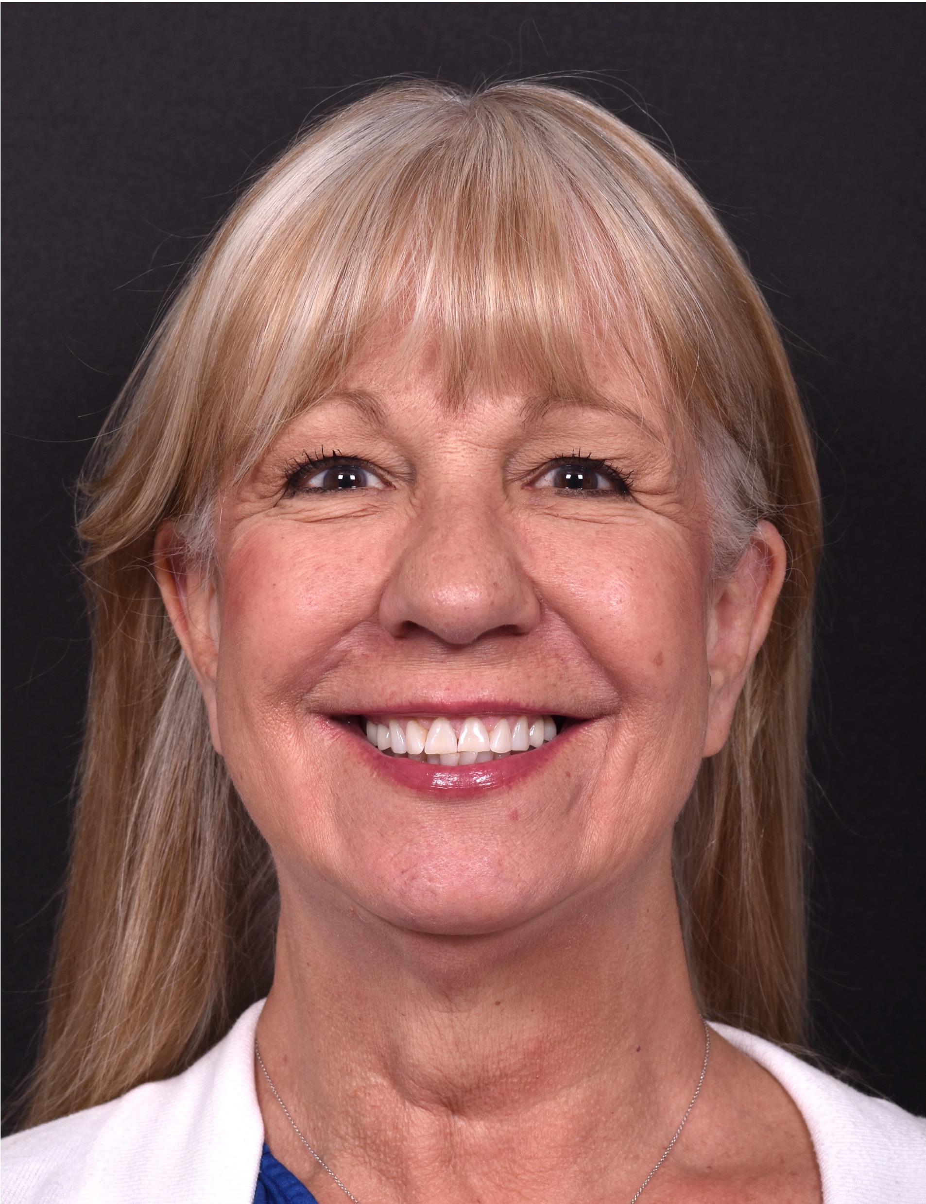 Before and after rhinoplasty results showing improved nasal shape and facial balance by Dr. Inessa Fishman at Aviva Plastic Surgery in Atlanta. Rhinoplasty nose job before and afer best expert near me collagen surgery plastic surgeon expert