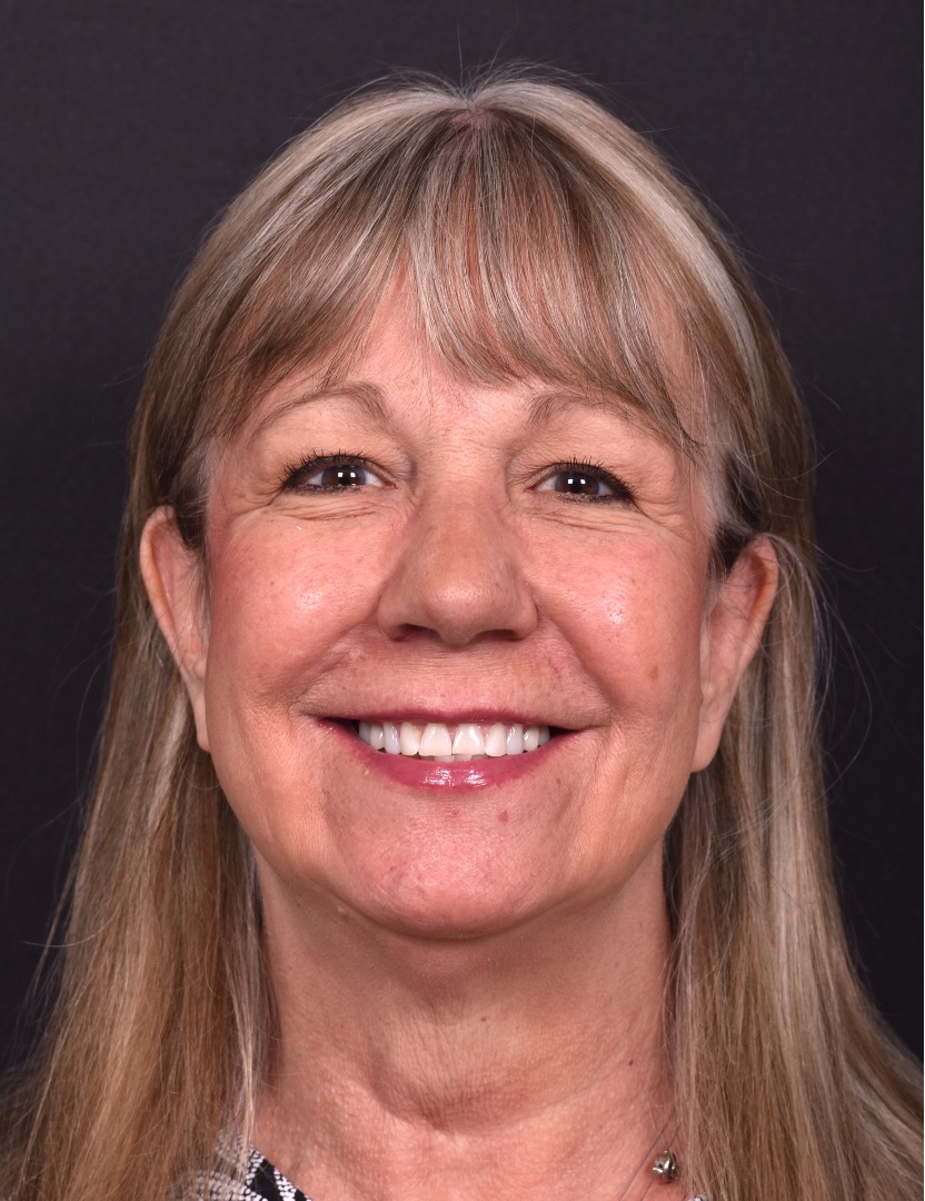 Before and after rhinoplasty results showing improved nasal shape and facial balance by Dr. Inessa Fishman at Aviva Plastic Surgery in Atlanta. Rhinoplasty nose job before and afer best expert near me collagen surgery plastic surgeon expert