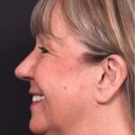 Before and after rhinoplasty results showing improved nasal shape and facial balance by Dr. Inessa Fishman at Aviva Plastic Surgery in Atlanta. Rhinoplasty nose job before and afer best expert near me collagen surgery plastic surgeon expert