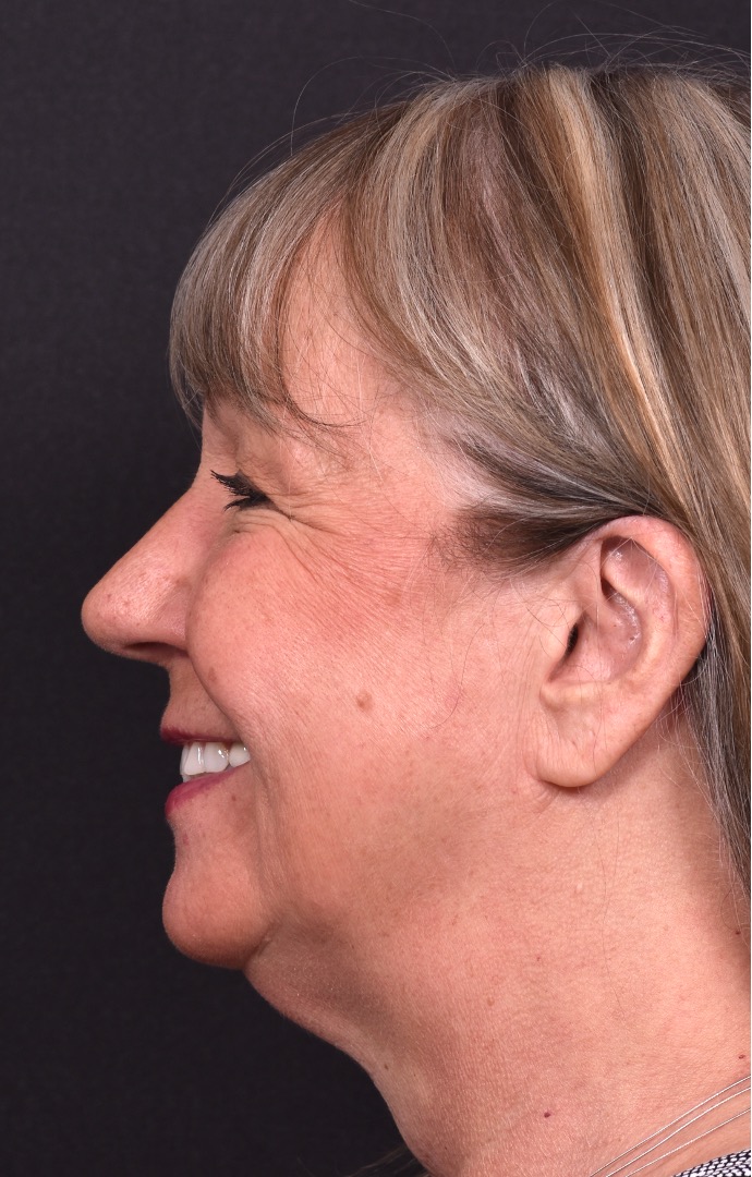 Before and after rhinoplasty results showing improved nasal shape and facial balance by Dr. Inessa Fishman at Aviva Plastic Surgery in Atlanta. Rhinoplasty nose job before and afer best expert near me collagen surgery plastic surgeon expert