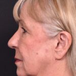 Before and after rhinoplasty results showing improved nasal shape and facial balance by Dr. Inessa Fishman at Aviva Plastic Surgery in Atlanta. Rhinoplasty nose job before and afer best expert near me collagen surgery plastic surgeon expert