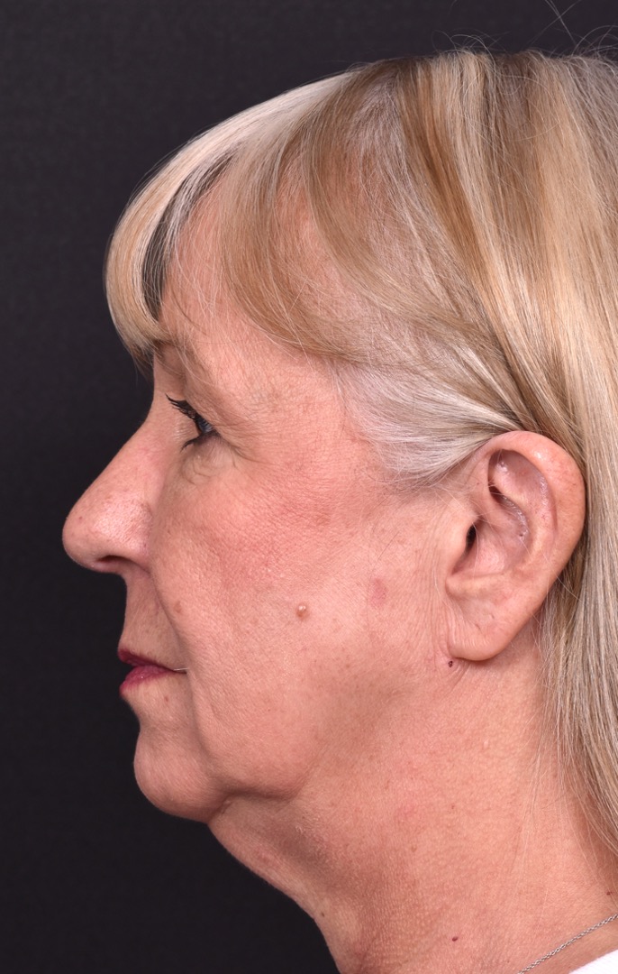 Before and after rhinoplasty results showing improved nasal shape and facial balance by Dr. Inessa Fishman at Aviva Plastic Surgery in Atlanta. Rhinoplasty nose job before and afer best expert near me collagen surgery plastic surgeon expert