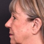 Before and after rhinoplasty results showing improved nasal shape and facial balance by Dr. Inessa Fishman at Aviva Plastic Surgery in Atlanta. Rhinoplasty nose job before and afer best expert near me collagen surgery plastic surgeon expert