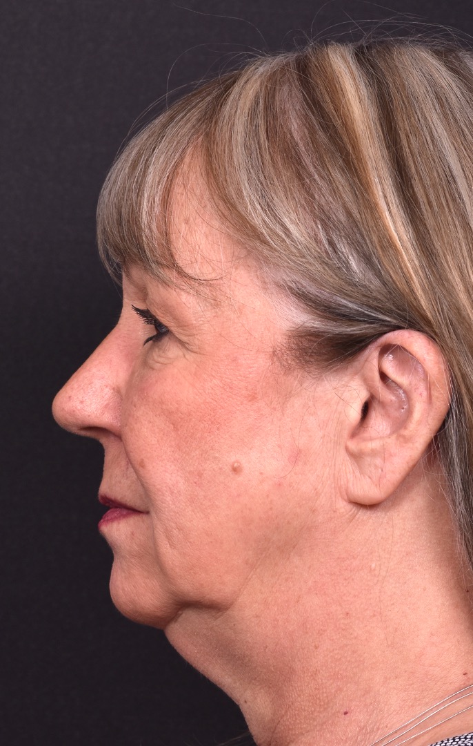 Before and after rhinoplasty results showing improved nasal shape and facial balance by Dr. Inessa Fishman at Aviva Plastic Surgery in Atlanta. Rhinoplasty nose job before and afer best expert near me collagen surgery plastic surgeon expert
