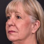 Before and after rhinoplasty results showing improved nasal shape and facial balance by Dr. Inessa Fishman at Aviva Plastic Surgery in Atlanta. Rhinoplasty nose job before and afer best expert near me collagen surgery plastic surgeon expert