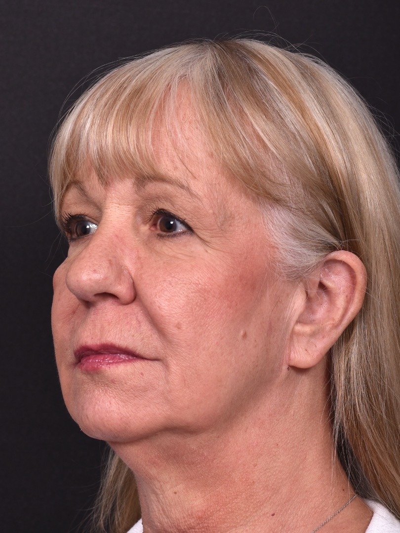 Before and after rhinoplasty results showing improved nasal shape and facial balance by Dr. Inessa Fishman at Aviva Plastic Surgery in Atlanta. Rhinoplasty nose job before and afer best expert near me collagen surgery plastic surgeon expert