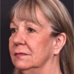 Before and after rhinoplasty results showing improved nasal shape and facial balance by Dr. Inessa Fishman at Aviva Plastic Surgery in Atlanta. Rhinoplasty nose job before and afer best expert near me collagen surgery plastic surgeon expert