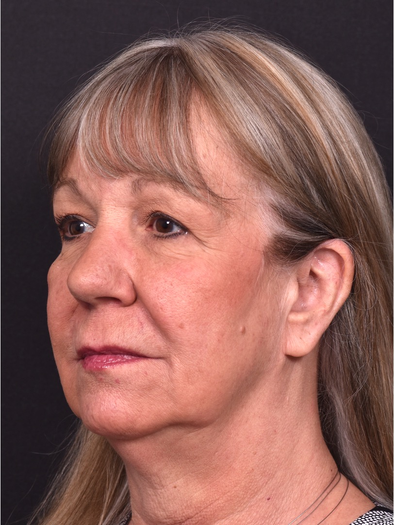 Before and after rhinoplasty results showing improved nasal shape and facial balance by Dr. Inessa Fishman at Aviva Plastic Surgery in Atlanta. Rhinoplasty nose job before and afer best expert near me collagen surgery plastic surgeon expert